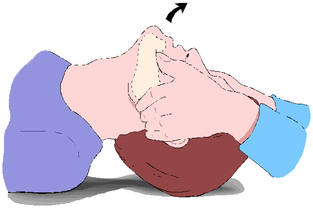 hiperextension